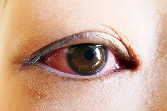 目の充血 原因と治療方法