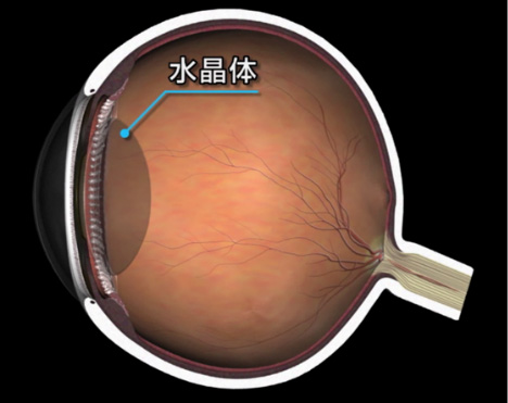 白内障　どんな病気？