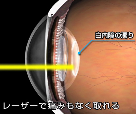 水晶体嚢にレーザー