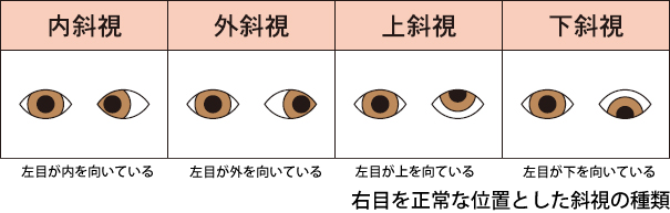 斜視の種類