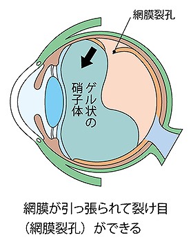 網膜が破損する病気