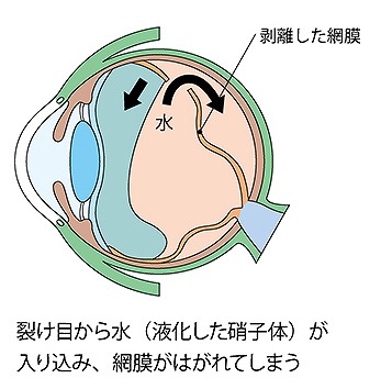 網膜が破損する病気