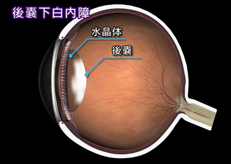 糖尿病白内障