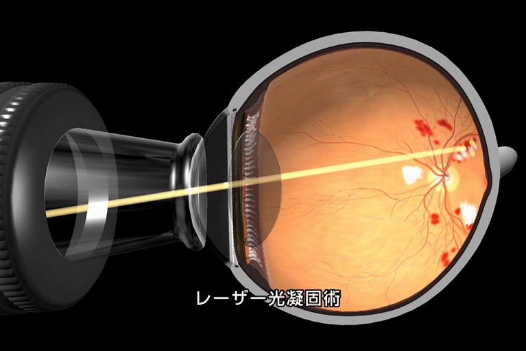 レーザー光凝固術