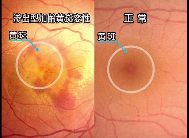 加齢黄斑と正常な眼底