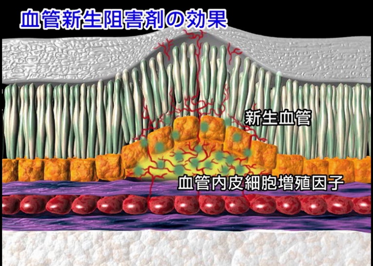 抗VEGF療法