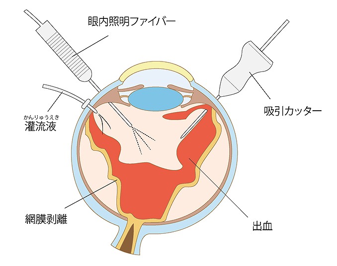 黄斑上膜の治療方法