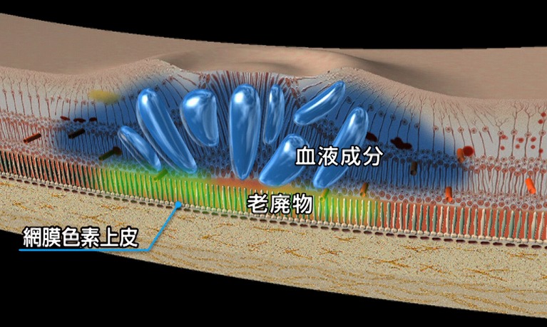 黄斑浮腫とは