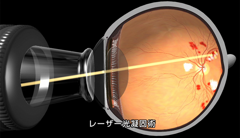目 の レーザー 治療 後 の 注意 点