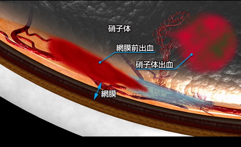 硝子体出血とは