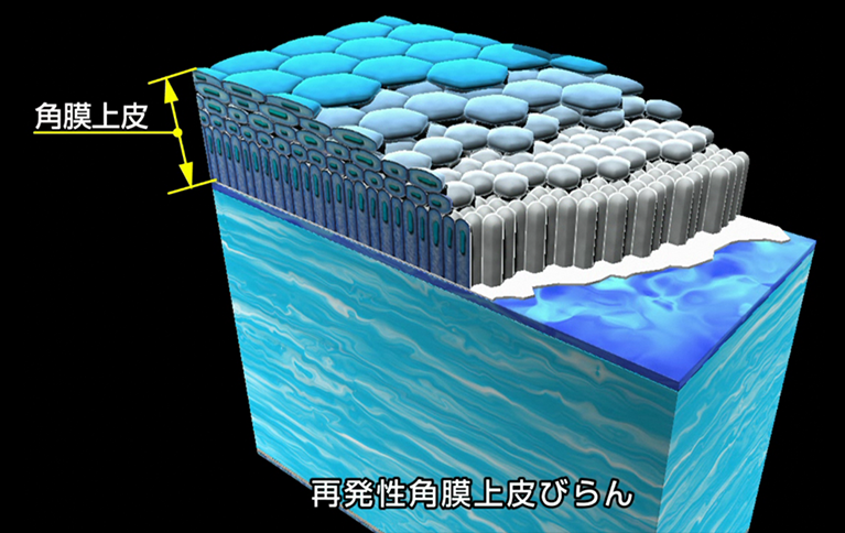 再発性角膜上皮びらん