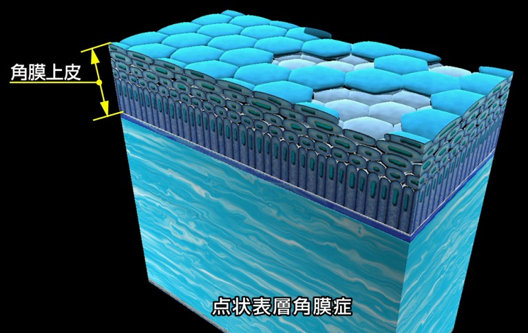 点状表層角膜炎