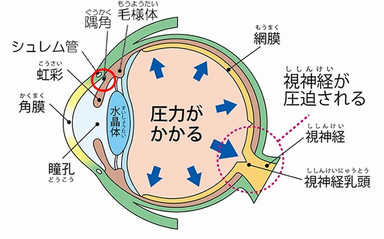 視神経 乳頭 陥没