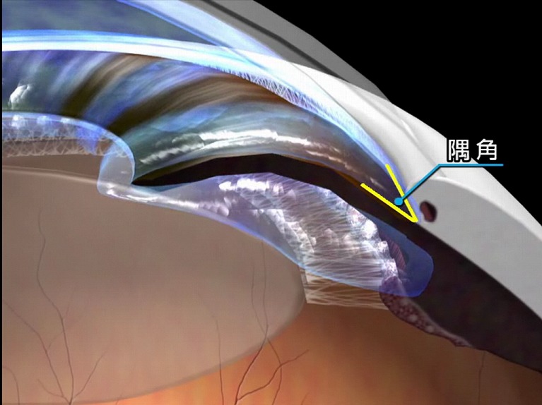 原発閉塞隅角緑内障