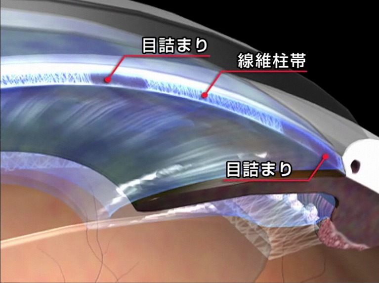 原発開放偶角緑内障