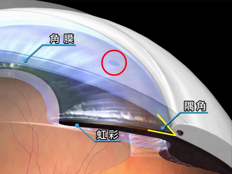 レーザー虹彩切開術（LI）