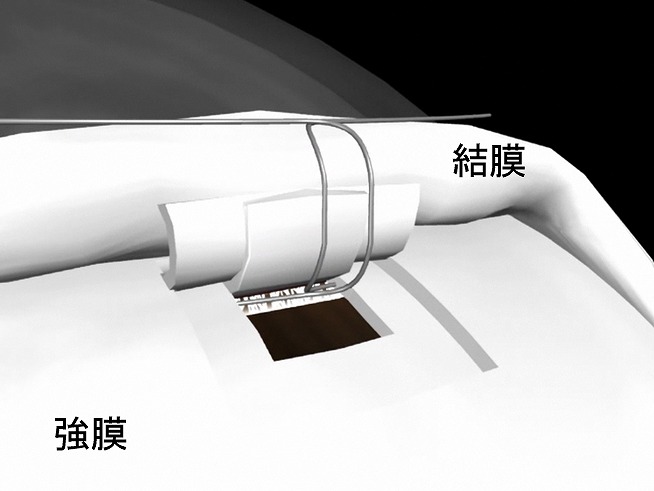 流出路再建術（トラベクロトミー）とは