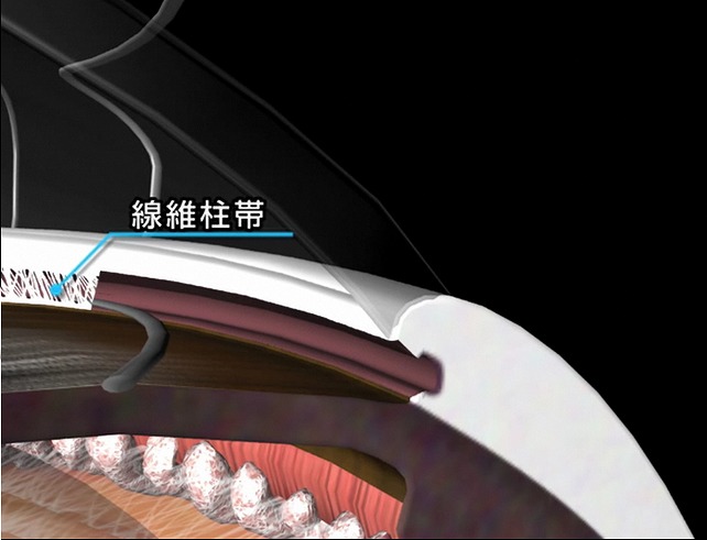 流出路再建術（トラベクロトミー）とは