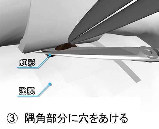 繊維柱帯切除術とは