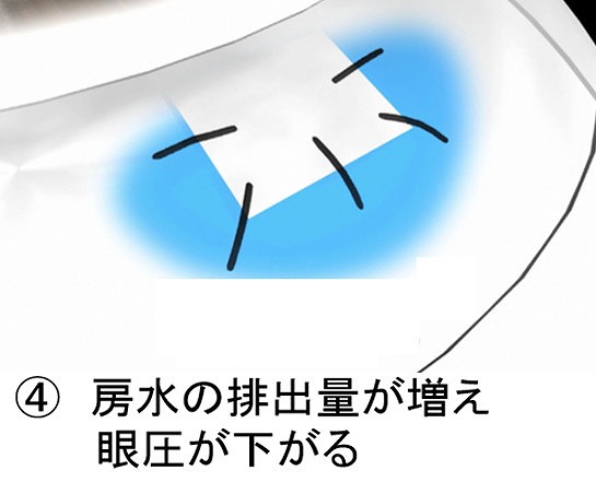 繊維柱帯切除術とは