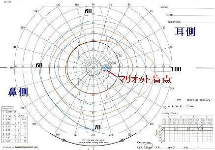 ゴールドマン視野計（動的計測）