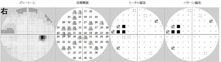 ハンフリー視野計、オプトス視野計（静的計測）