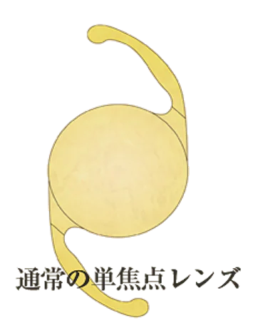 単焦点眼内レンズとは